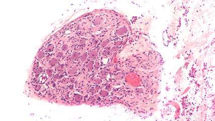 Histology of a peripheral nerve ganglion.  Ganglia such as this are commonly present as incidental...