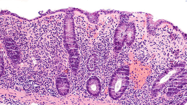 Microscopic image of biopsy obtained during colonoscopy from a patient with painful bloody diarrhea showing chronic ulcerative colitis, a type of inflammatory bowel disease (IBD).