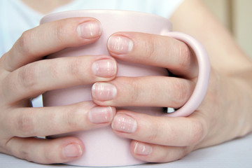 Obraz na płótnie Canvas Many white spots on fingernails ( Leukonychia ) due to calcium deficit or stress. Female hands holding mug