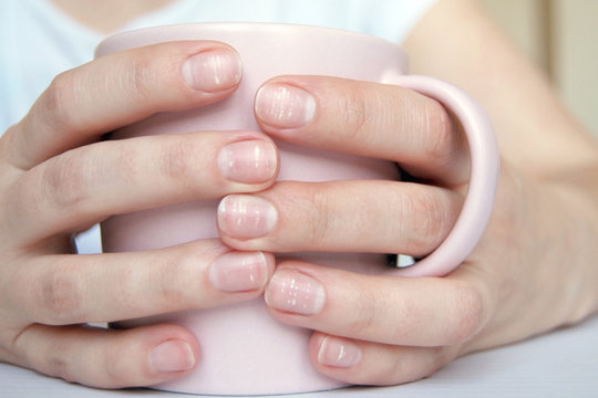 Many white spots on fingernails ( Leukonychia ) due to calcium deficit or stress. Female hands holding mug