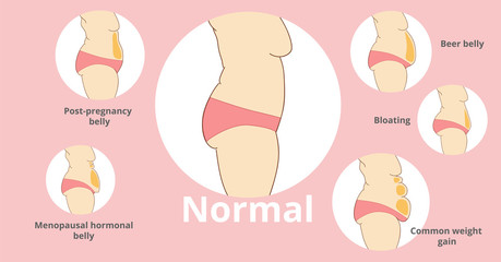 Types of female tummies banner. Tummy tuck surgery or abdominoplasty vector illustration. Medical advertising of cosmetic plastic procedures.