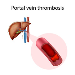 Portal vein thrombosis. Vector medical anatomy illustration.