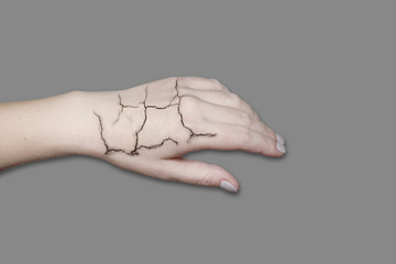 Hand with cracked skin. Cracked skin, dry skin. Skin care in winter, moisturizing the skin