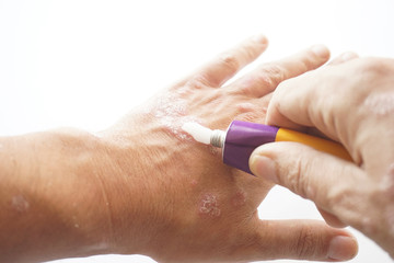 Patient squeezes out of aluminum tubes ointment with medicinal substance on finger. Photo of use of drug in form of ointments for application on skin and treating skin diseases, psoriasis, acne - obrazy, fototapety, plakaty
