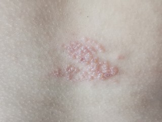 Herpes zoster, shingles on the skin. The initial stage with bubbles on the skin