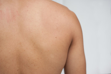 Fototapeta na wymiar Acne skin. Acne skin on the back. Human skin.