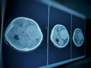 CT Brain Seven cm. diameter hyperdensity mass with lobulated surface at extra-axial lateral to Lt...