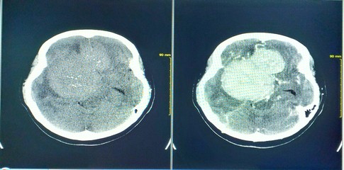 CT Scan Showing Mass or tumor inside the brain.
