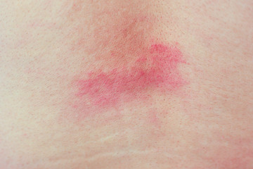 Adult male body skin irritation and allergy, Atopic Dermatitis or Atopic Eczema red rash