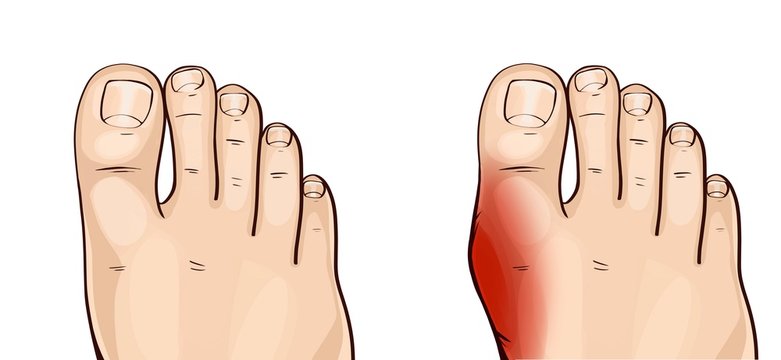 Hallux valgus is the commonest forefoot deformity