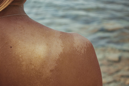 The girl's sunburned shoulder. Peels and flakes the skin on the back and shoulder from the sun