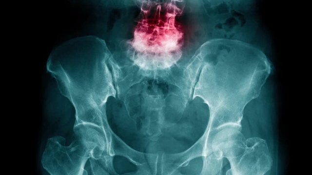 l-spine degenerative change with red hight light 