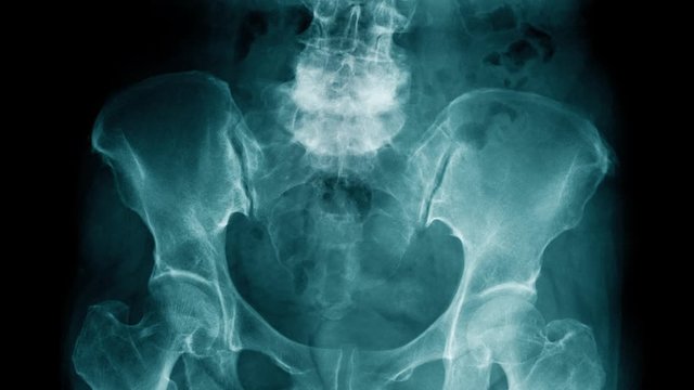 l-spine degenerative change with red hight light 