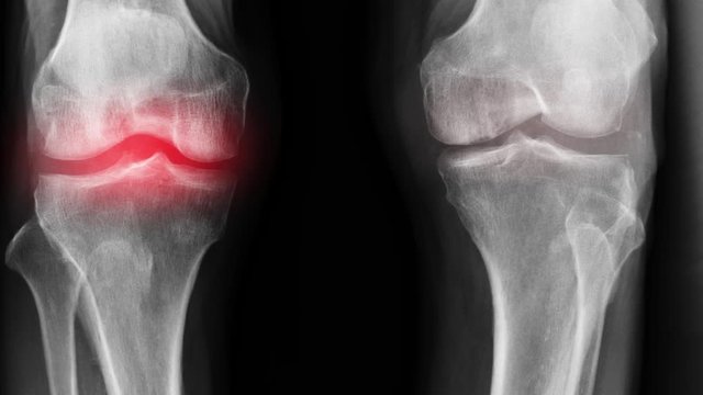 l-spine degenerative change with red hight light 
