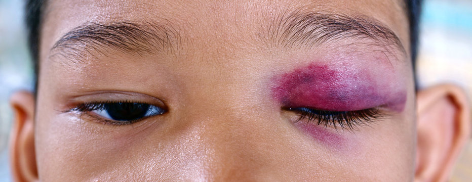 Close-up of bruised eye of asian boy, black and blue wound hurt from accident.