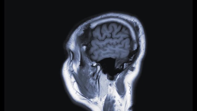 Magnetic resonance imaging (MRI) of the brain in sagittal  plane T1 technique for check anatomical.