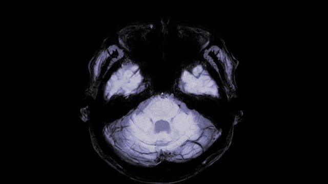MRI brain or magnetic resonance imaging of the brain in axial view  showing anatomical of the brain.