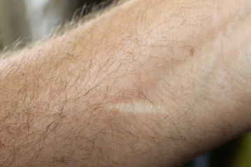 Fototapeta premium Arm Scar