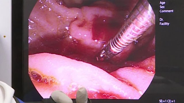 Doctors use medical instruments and video cameras to perform abdominal surgery .
