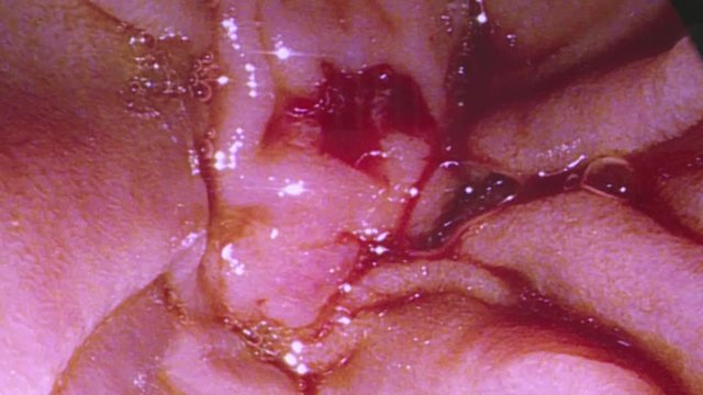 Doctors use medical instruments and video cameras to perform abdominal surgery .