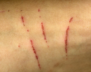 cat scratch skin, claw mark