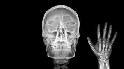 Film X ray radiograph show human anatomy of skull bone and skeleton which skeletal hand show sign...