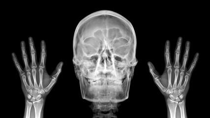 Film X ray radiograph show human anatomy of skull bone and skeleton which skeletal hand show sign...