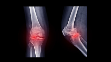 Film X-ray knee radiograph show rheumatoid arthritis disease (RA knee disorder) with Valgus...