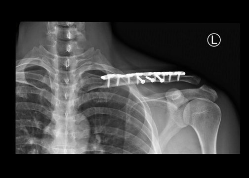 film x-ray shoulder radiograph showing fracture clavicle bone after traffic accident. The patient treated by open reduction internal fixation (ORIF) with plate and screws. medical imaging concept