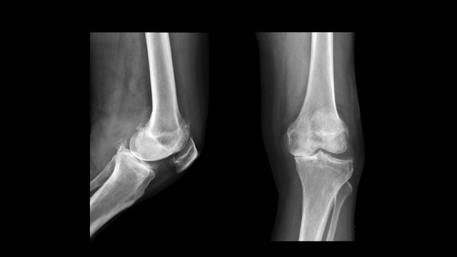 Film X ray knee radiograph show degenerative osteoarthritis disease (OA knee disorder). The patient has knee pain and varus deformity problem (bowlegged deformity). Medical technology concept