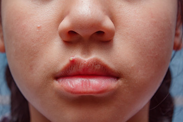 Young woman with pimples on face.