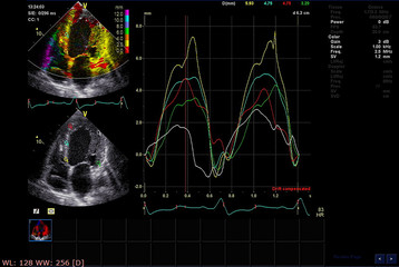 Screen of echocardiography (ultrasound) machine.