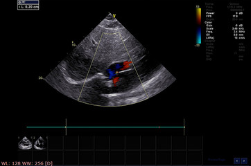 Screen of echocardiography (ultrasound) machine.