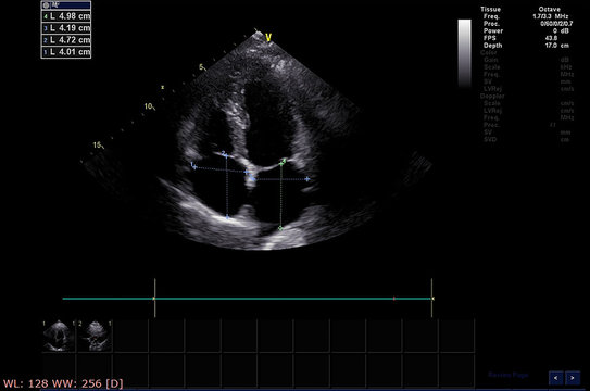 Screen of echocardiography (ultrasound) machine.