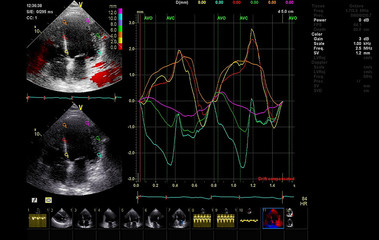Screen of echocardiography (ultrasound) machine.
