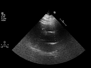 Screen of echocardiography (ultrasound) machine.