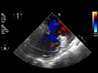 Screen of echocardiography (ultrasound) machine.