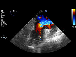 Screen of echocardiography (ultrasound) machine.