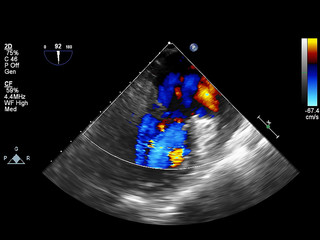 Screen of echocardiography (ultrasound) machine.