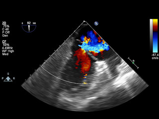 Screen of echocardiography (ultrasound) machine.