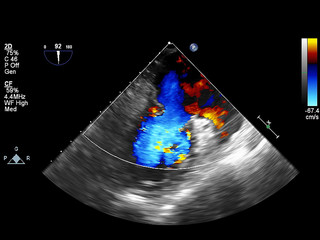 Screen of echocardiography (ultrasound) machine.