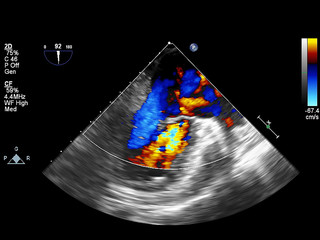 Screen of echocardiography (ultrasound) machine.