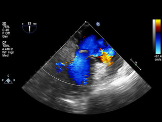 Screen of echocardiography (ultrasound) machine.