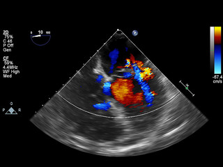 Screen of echocardiography (ultrasound) machine.