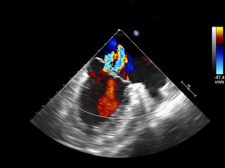 Screen of echocardiography (ultrasound) machine.