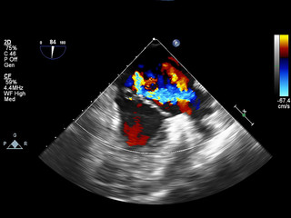 Screen of echocardiography (ultrasound) machine.