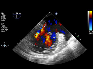 Screen of echocardiography (ultrasound) machine.