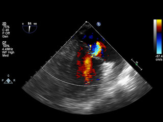 Screen of echocardiography (ultrasound) machine.