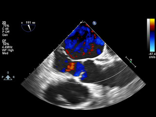 Screen of echocardiography (ultrasound) machine.