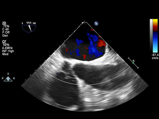 Screen of echocardiography (ultrasound) machine.